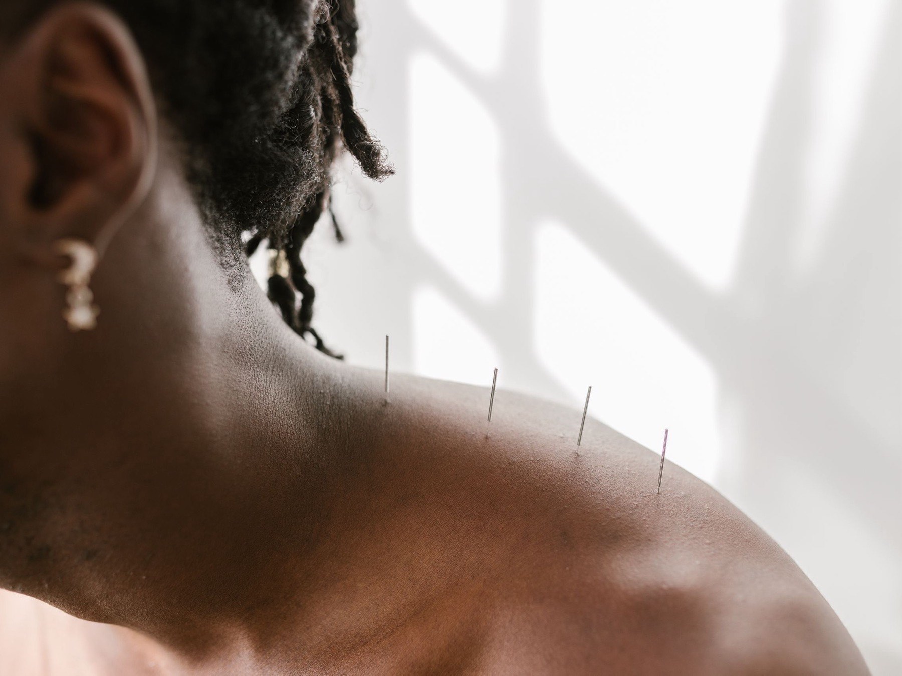Acupuncture needles placed along a patient's shoulder